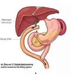 肠吻合术视频,肠吻合术操作步骤与技巧解析